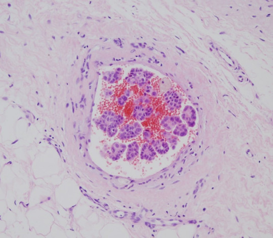 48. Histologický preparát – tumor, trombus.