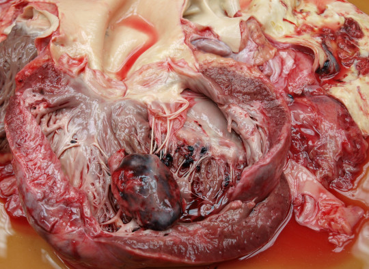 49. Trombus v srdeční komoře.