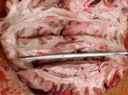 51. Edém mozku, tkáň se tzv. lepí na nůž.