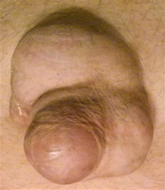65. Hernia umbilicalis.