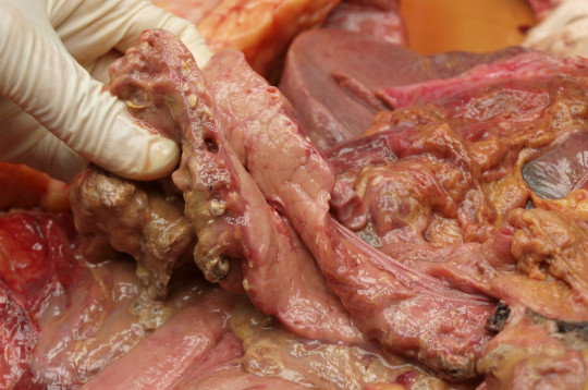 66. Akutní pancreatitis.