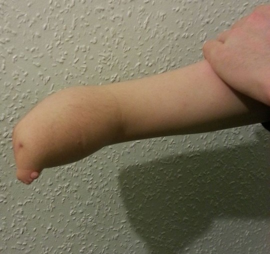 10. Fokomelie horní končetina