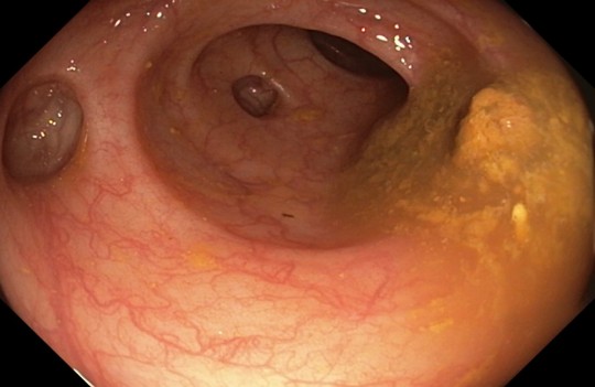 2. Divertikly tlustého střeva