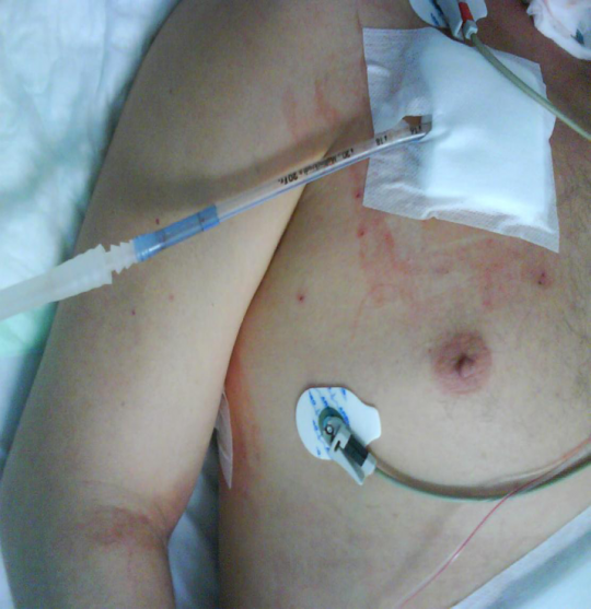 20. Pacient s hrudním drénem