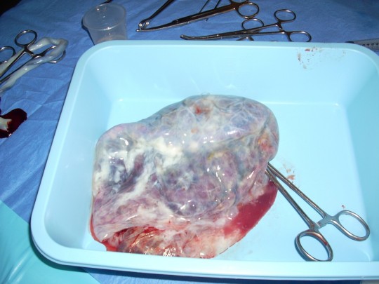 12. Placenta