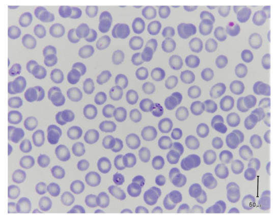 11. Původce tropické malárie – Plasmodium falciparum. Infikované erytrocyty