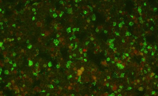 27. Nepřímá imunofluorescence, pozitivní průkaz protilátek proti antigenu VCA (virový kapsidový antigen) viru Epstein-Barrové, pozitivní