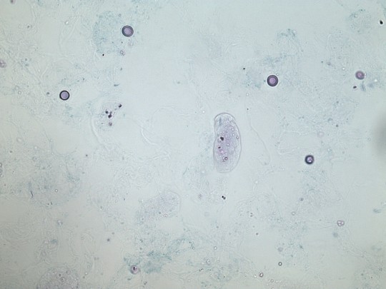 27. Hyalinní válec a erytrocyty (foto Ing. Ivana Hupáková, ÚKBH Plzeň)