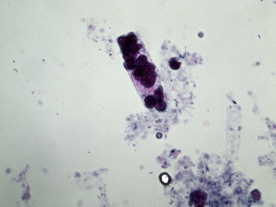 30. Válec z renálních tubulárních epitelií (foto Ing. Ivana Hupáková, ÚKBH Plzeň)