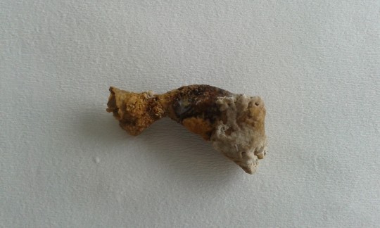 41. Odlitkový konkrement – vyplňuje část nebo celý dutý systém ledviny (Ing. Ivana Hupáková, ÚKBH Plzeň)