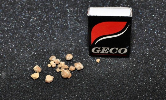 47. Struvit + apatit (Ing. Ivana Hupáková, ÚKBH Plzeň)