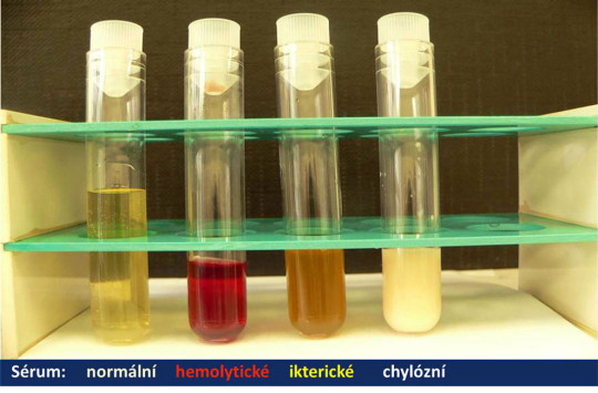 Vzhled séra normálního, hemolytického, ikterického a chylózního