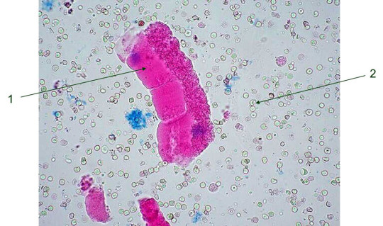 Nález v močovém sedimentu při chronické glomerulonefritidě; 1 = granulovaný válec s přechodem do válce voskového, 2 = dysmorfní erytrocyty.
