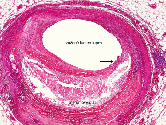 Histologický obraz řezu tepnou postiženou aterosklerózou; šipka ukazuje zeslabení vazivového krytu aterosklerotického plátu, kde může dojít k ruptuře a následnému růstu trombu