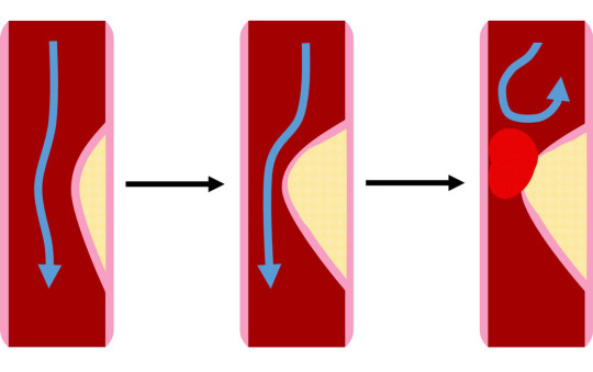 Příčinou akutního infarktu myokardu je nejčastěji trombotický uzávěr věnčité tepny, který nasedá na rupturu aterosklerotického plátu
