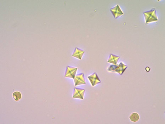Krystaly oxalátu vápenatého v močovém sedimentu při otravě etylenglykolem