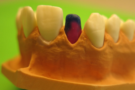 2. Vosková modelace kovové konstrukce metalokeramické korunky