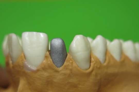 3. Očištěná kovová konstrukce před vrstvení keramické hmoty