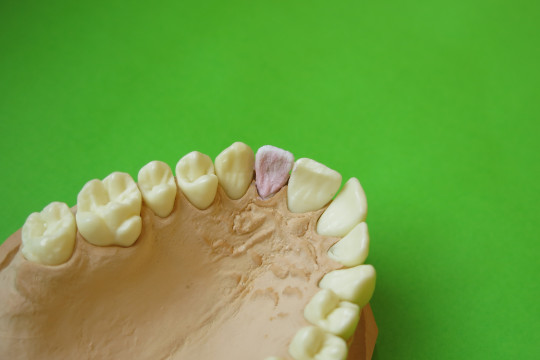 6. Keramická hmota před vypálením nanesená na kovové konstrukci