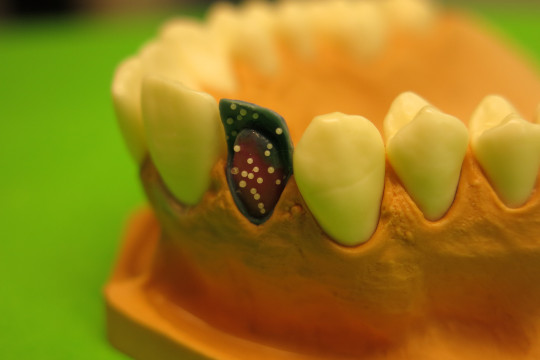 8. Voskový model kovové konstrukce fazetové korunky