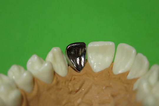 11. Vyleštěná kovová konstrukce fazetové korunky