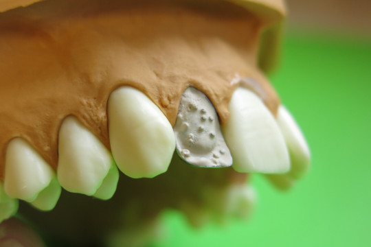 13. Podbarvení kovové konstrukce fazetové korunky