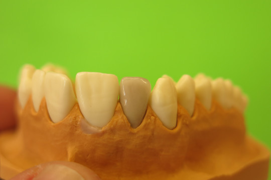 14. Konečná podoba fazetové korunky před odevzdáním pacientovi