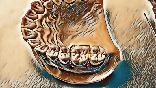 38. Adamsova spona v zubním oblouku