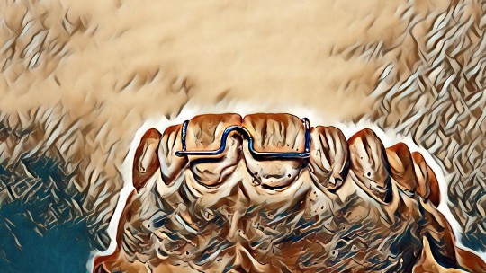 39. Adamsova spona ve frontálním úseku