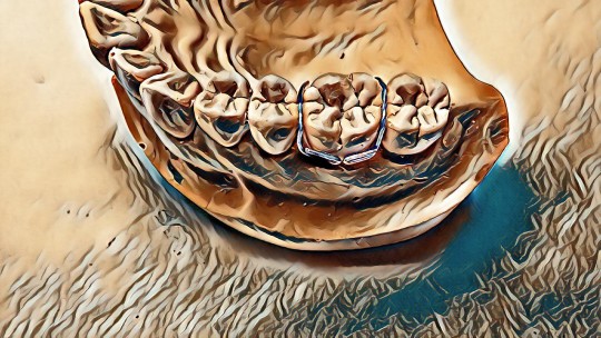 42. Duyzingsova spona