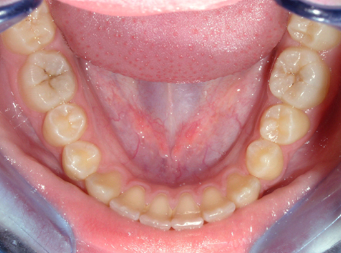 2. Dolní zubní oblouk se zubním kamenem interdentálně mezi dolními řezáky