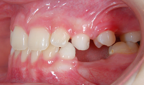 4. Kaz ve smíšeném chrupu – bílá skvrna s počínající pigmentací na 36 M a bílá skvrna přecházející v kavitaci na 63 D