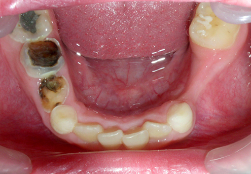5. Kariézní léze ve smíšeném chrupu – sekundární kaz na 46 O, rozsáhlé destrukce zubů 84, 85