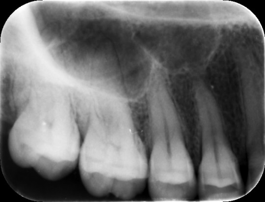 16. Apikální snímek