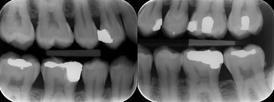 19. Bite wing (skusový snímek)