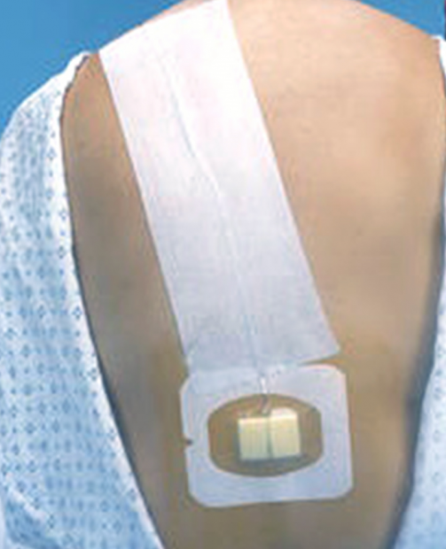 14. Epidurální katetr, fixace