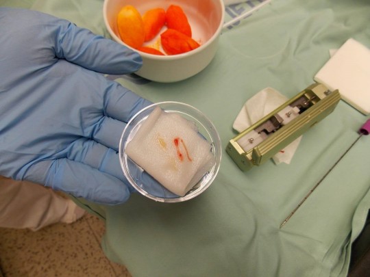 36. Odebrané vzorky štěpu z transplantované ledviny