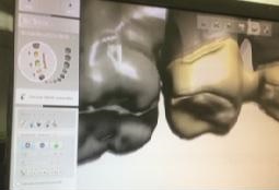 6. Virtuální modelování náhrady