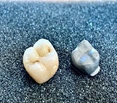 20. Metalokeramická korunka: vlevo hotová, vpravo základní kovový plášť