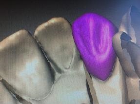 25. Virtuální modelování náhrady